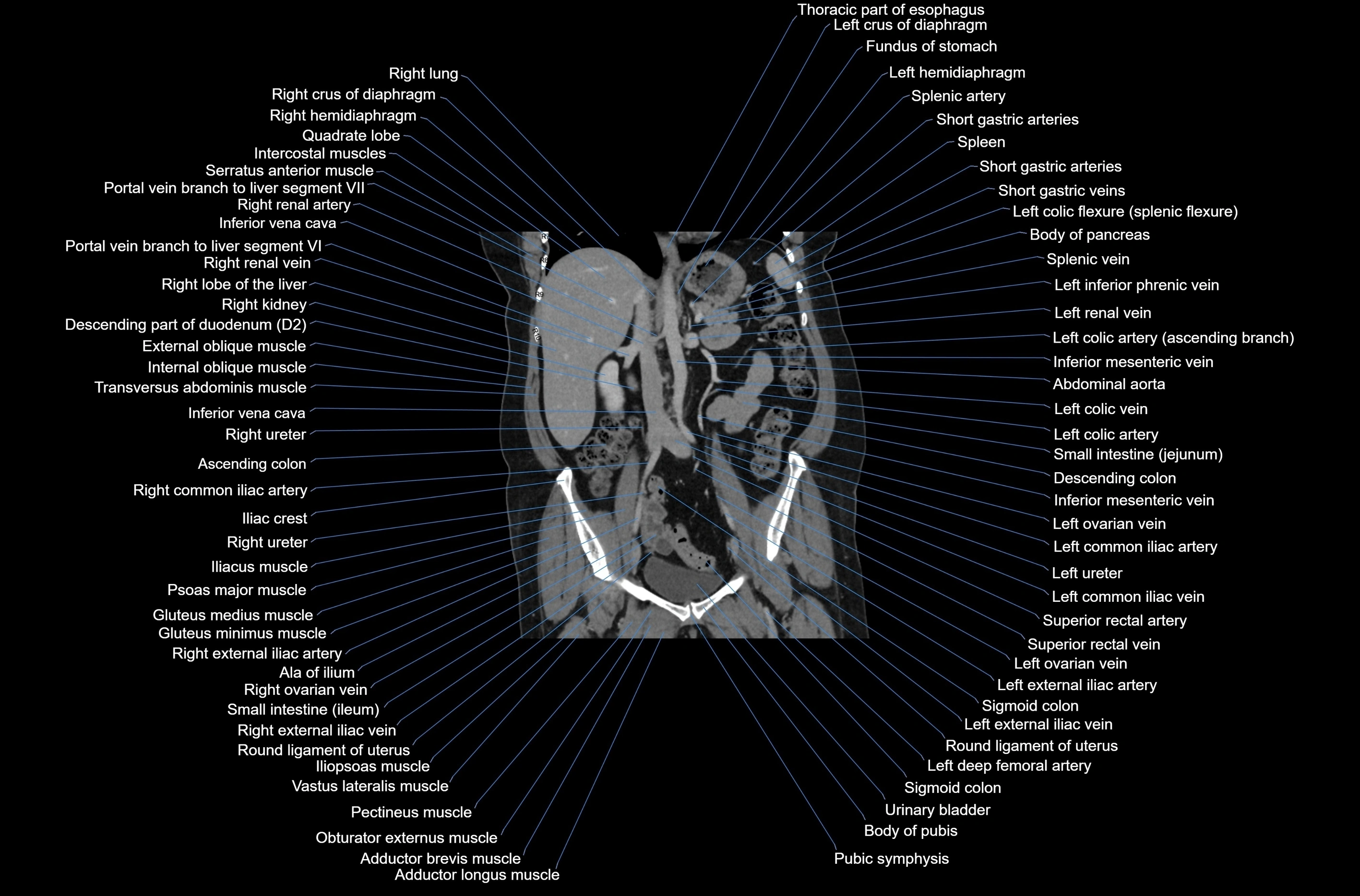 CT abdomen coronal cross sectional anatomy labelled radiology image-00046.webp